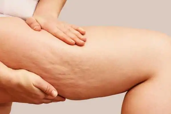 Image of woman showing leg with cellulite Purfleet
