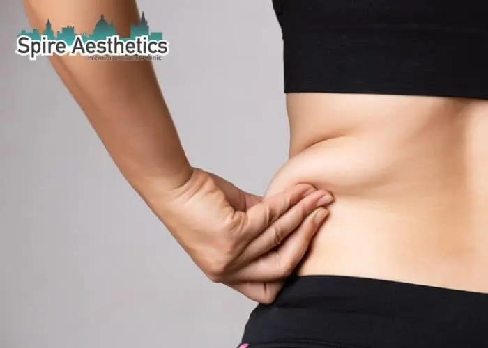Image of woman pinching fat on their hips Purfleet. Fat Freezing treatment