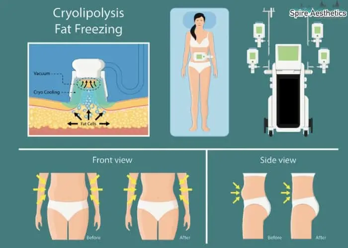 Fat freezing treatment Purfleet benefits for competitions to remove stubborn fat deposits.