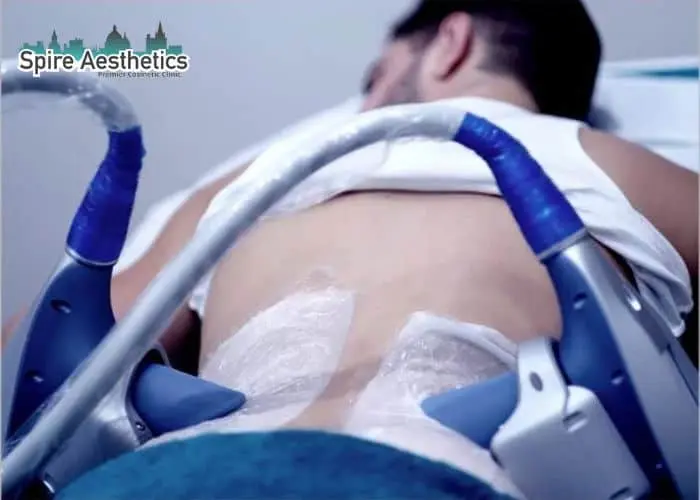 Man having fat freezing treatment done on love handles before a competitions Purfleet to create a sculpted look.