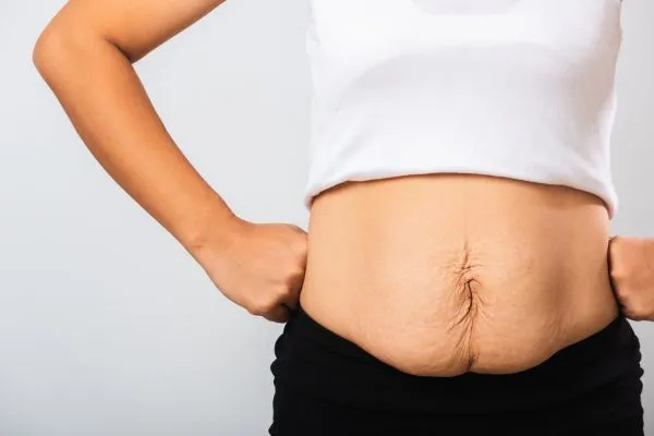 Image of a woman's stomach after weight loss with sagging skin following a gastric band Purfleet