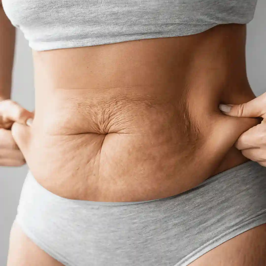 Is It Normal to Have Loose Skin After Pregnancy Purfleet?