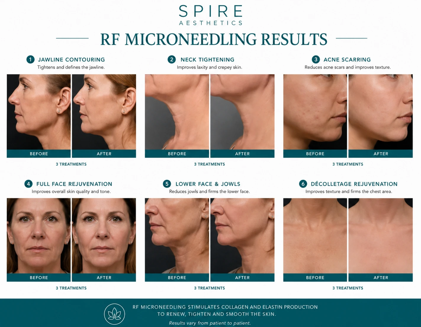 RF Microneedling Skin tightening Purfleet results