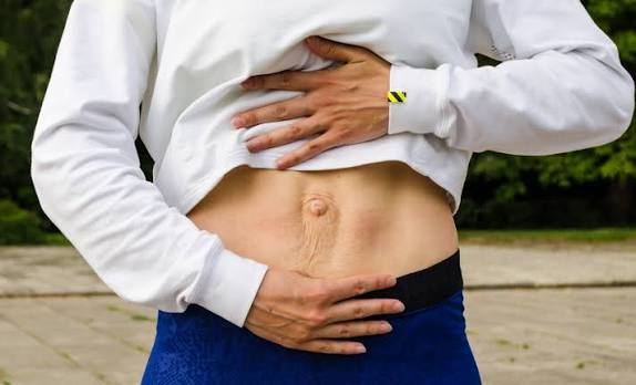 When Could Diastasis Recti Be the Missing Piece of the Puzzle Purfleet?