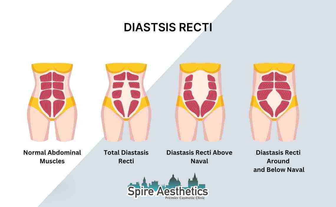 Is Non-Surgical Diastasis Recti Treatment Right for You? Common Concerns Answered Purfleet